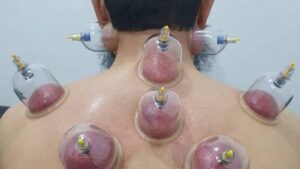 وأفضل أوقات الحجامة هو شهر فبراير طبقاً للسنة النبوية الشريفة